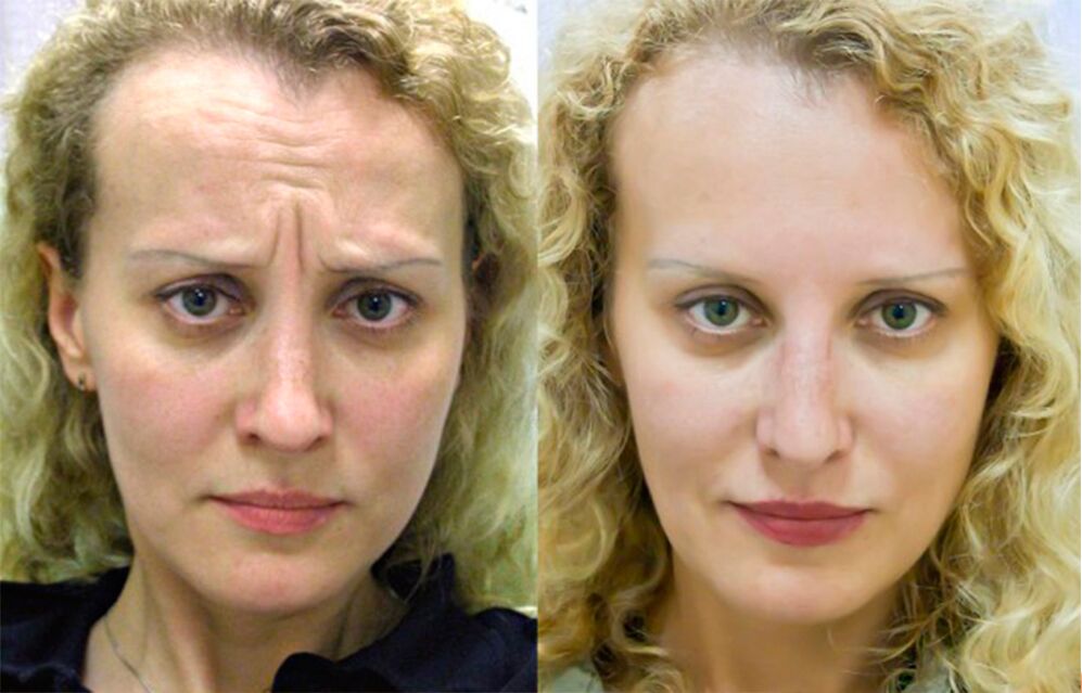 ennen ja jälkeen hierontalaitteen käytön nuorentumiseen ltza kuva 1