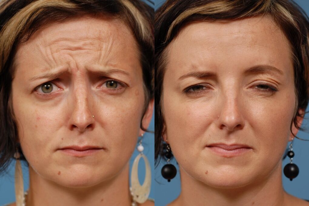 ennen ja jälkeen hierontalaitteen käytön nuorentumiseen ltza kuva 2