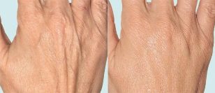 Käsi-iho ennen jaehoitoa ja sen jälkeen